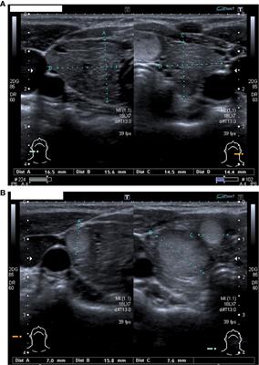 Case Report - Multinodular goiter in a patient with Congenital Hypothyroidism and Bannayan-Riley-Ruvalcaba syndrome: the possible synergic role of TPO and PTEN mutation